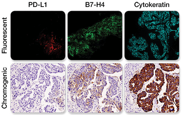 IHC 染色实例 PDL1 B7H4 细胞角蛋白